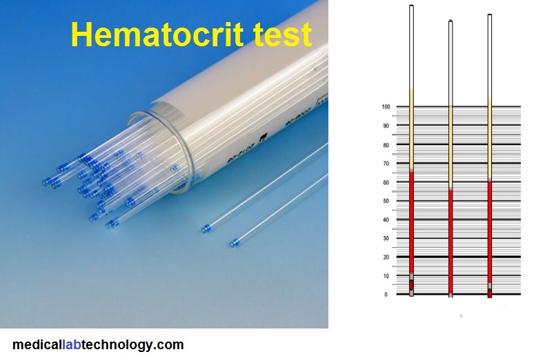 Hematocrit test (HCT-PCV) procedure, range, result