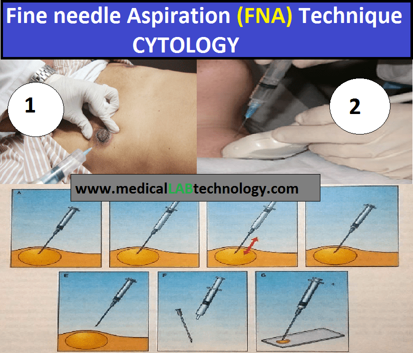 Fine needle aspiration biopsy procedure  thyroid cytology (fnac), complications