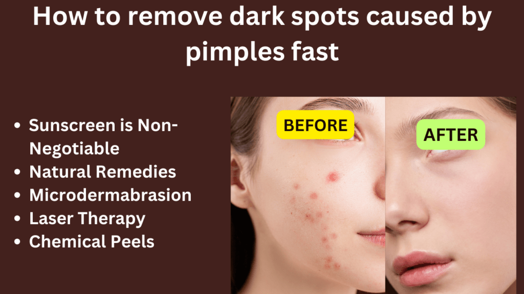 How to remove dark spots caused by pimples fast