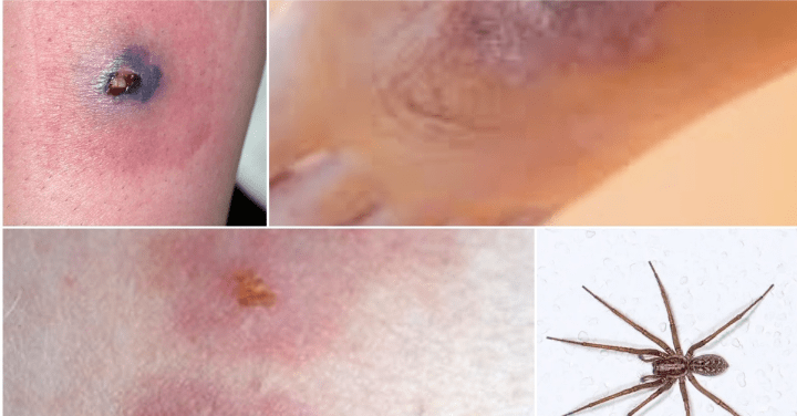 Hobo Spider Bite: Symptoms, Treatment, and Prevention